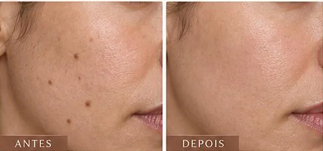 Antes e depois ilustrativo, Clear Skin