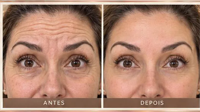 Antes e depois ilustrativo, Seoul Tox Lift